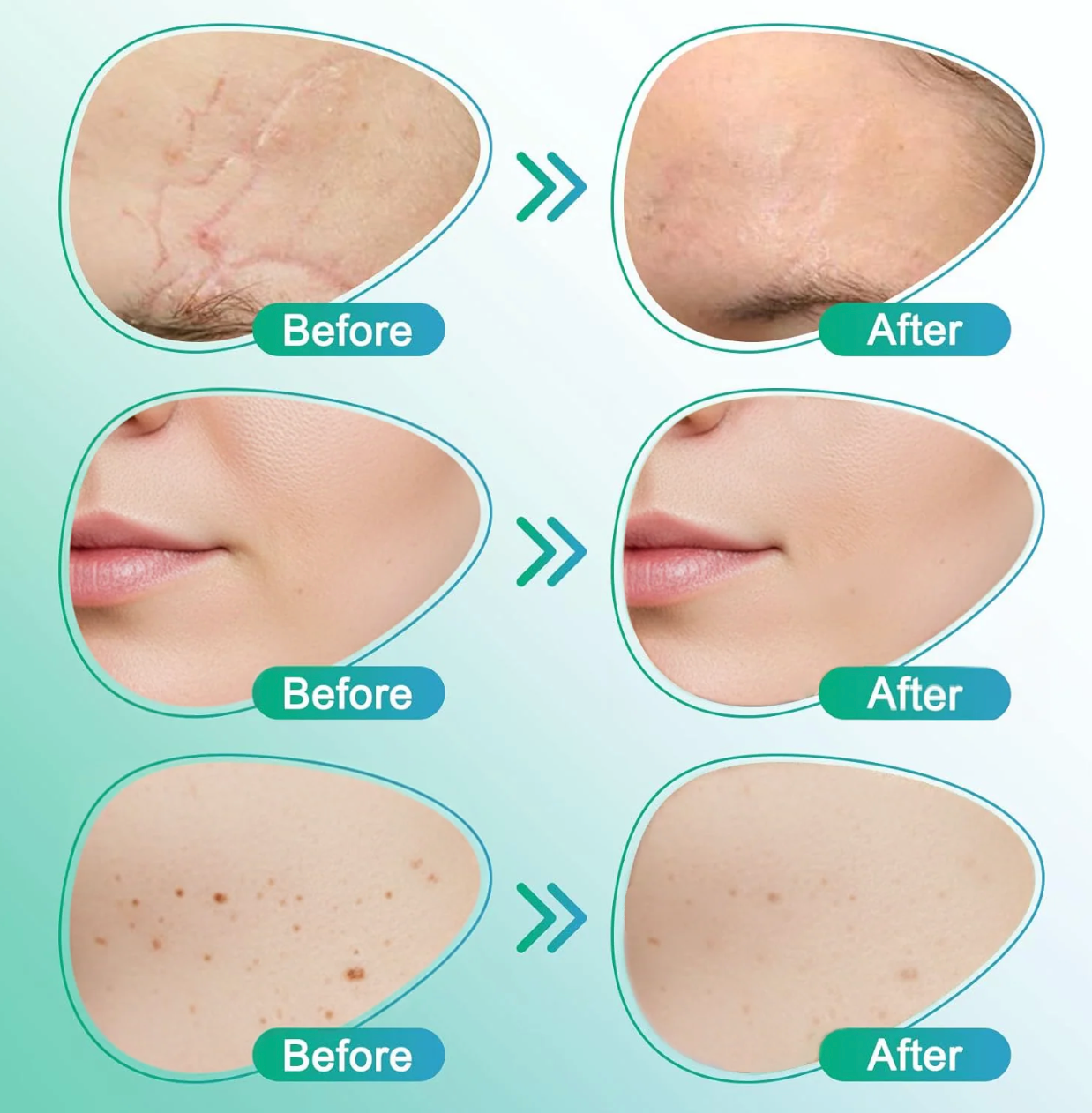 Micro-needle Skin Care Patch